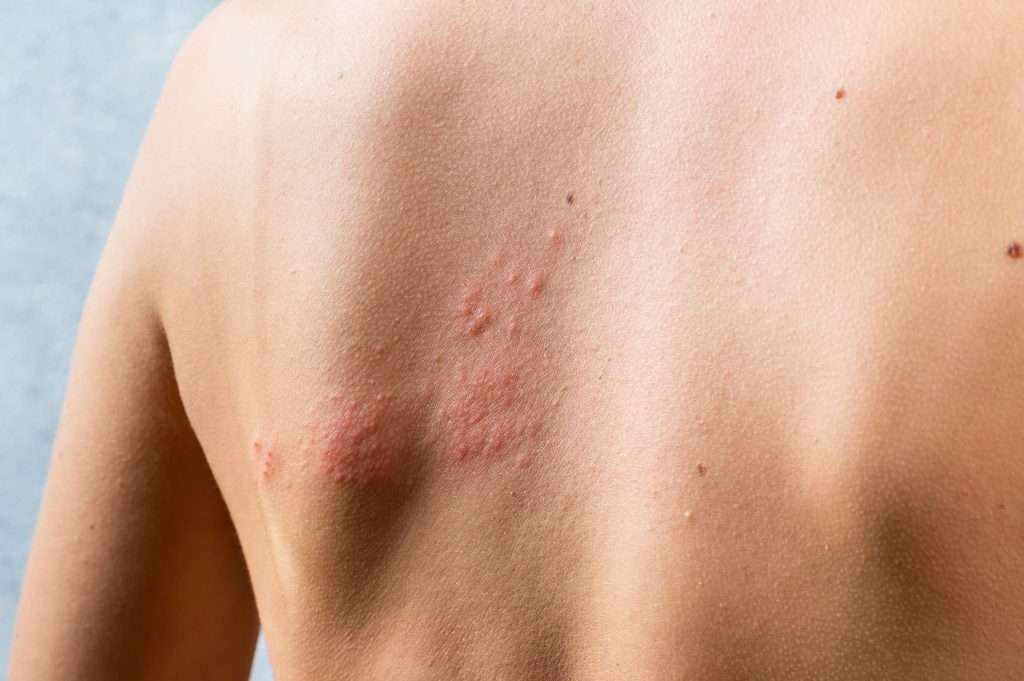 A mild shingles rash visible on a person’s left shoulder blade.